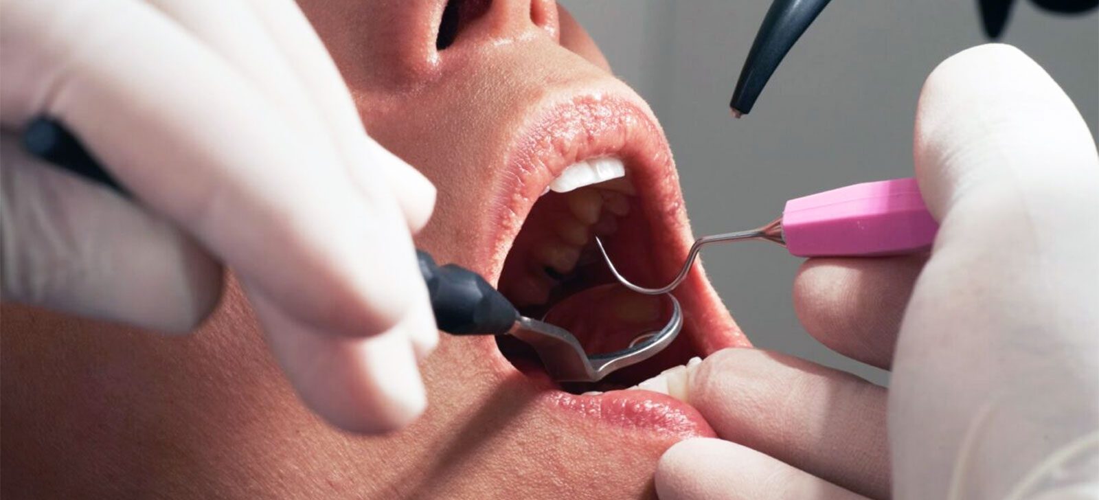Do You Need Scaling and Polishing If You Brush Well? What to Expect
