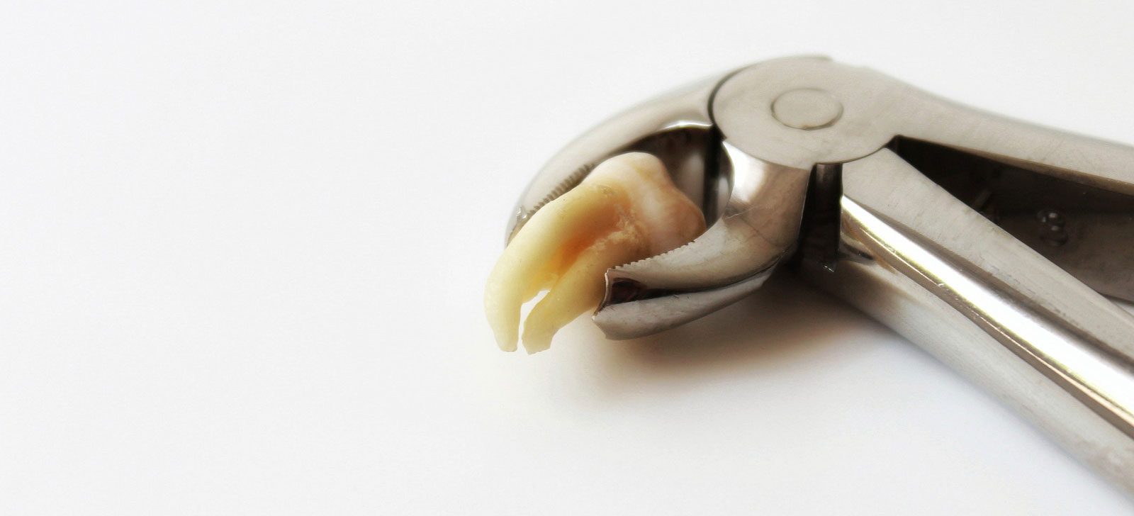 Do You Need Wisdom Tooth Surgery? Removal, Monitoring and Risks
