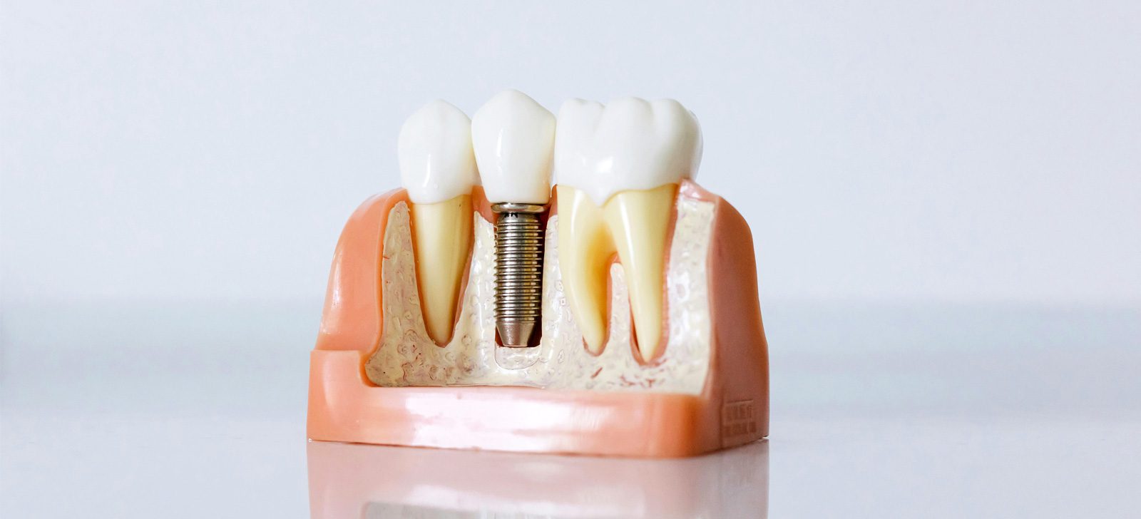 Dental implant supporting a replacement tooth