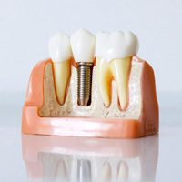 Why Choose Dental Implants?