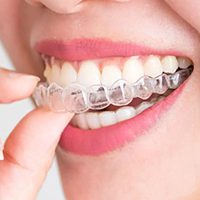 Is Invisalign Painful? What the First 2 Weeks Feel Like
