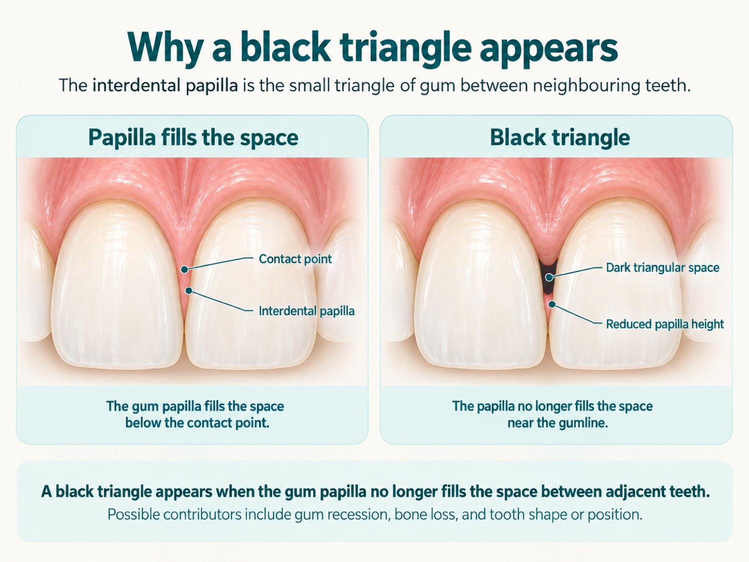Labelled diagram comparing healthy gums, where the interdental papilla fills the space below the contact point, with a black triangle, where reduced papilla height leaves a dark triangular space between the front teeth near the gumline.